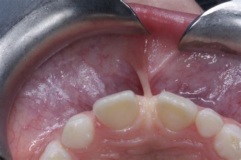 Frenectomy for a Child .